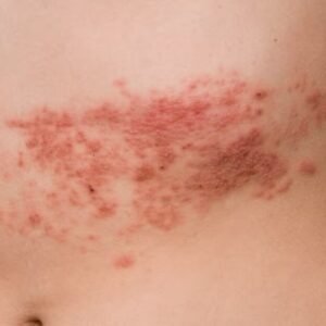 Herpes-zóster: conheça causas, sintomas e tratamento