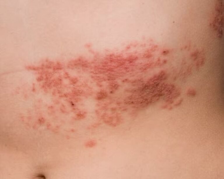 Herpes