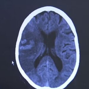 AVC tira a vida de um brasileiro a cada seis minutos; 80% dos casos poderiam ser evitados