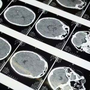 Doenças priônicas: os enigmas das proteínas que ‘entortam’ e destroem o cérebro