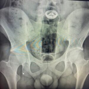 Paciente é internado após ficar com desodorante preso no reto; médicos fazem alerta