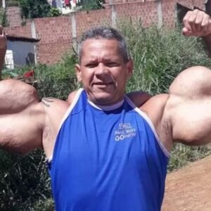 ‘Popeye Brasileiro’: entenda riscos de injetar óleo mineral no corpo para tonificar músculos