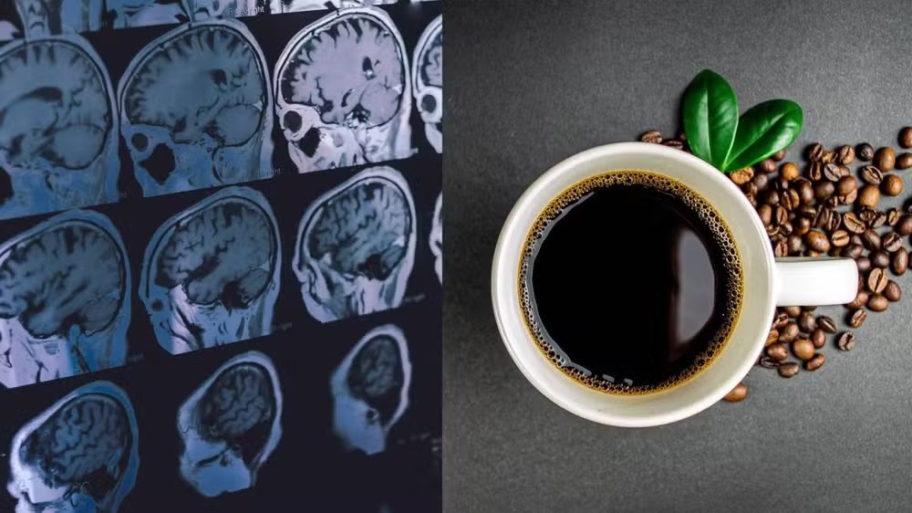 Café pode reduzir a chance de demência, diz estudo