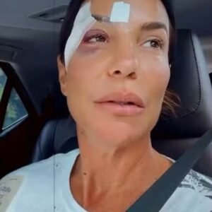 Com olho roxo, Ivete recebe alta de hospital em Salvador e explica quadro de saúde