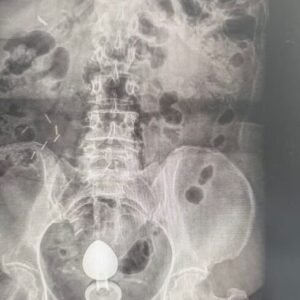 Mulher é internada após plug anal ficar preso no intestino; médicos alertam para riscos no uso do acessório