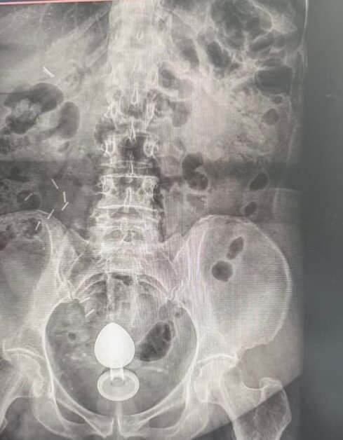 Mulher é internada após plug anal ficar preso no intestino; médicos alertam para riscos no uso do acessório