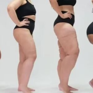 Lipedema: saiba mais sobre a doença confundida com obesidade e celulite
